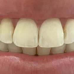 D on D Dental - Teeth before my accident