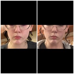 Kalos Medical Spa at Kirby Plastic Surgery - Before and after dysport(20 units each cheek) for facial slimming. 1 month difference.