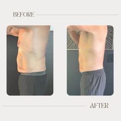 OC Body Clinic - Body sculpting results