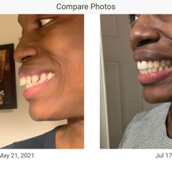 Riverdale Family Orthodontics - My journey from beginning to end