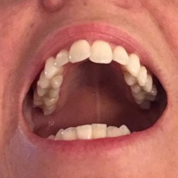 Studio Dental - About a week or two into Invisalign - General Dentistry Near Me - San Francisco, California Studio Dental - About a week or two into Invisalign - General Dentistry Near Me - San Francisco, California