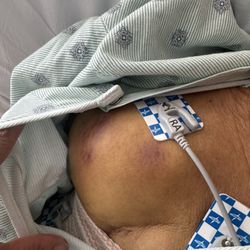 Arden Courts of Palos Heights - Hematoma on chest from blunt force-Arden Court Palos Heights