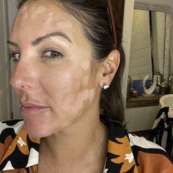 Cosmetic and Reconstructive Specialists of Florida - Burns