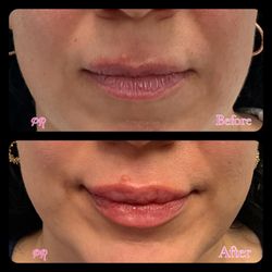 Perpetual Radiance Medical Aesthetics - Lip Rejuvenation