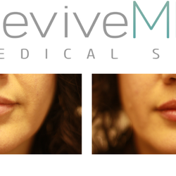 ReviveMD - 1/2 CC Juvederm Lips.  Perfect little plump added to top and bottom lips.