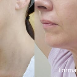 Elijah Rochelle MD - Forma treatment can help tighten skin at face and neck