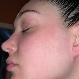 Day after Hydrafacial, by Expert Medical Aesthetician, Sanela Pjetrovic Day after Hydrafacial, by Expert Medical Aesthetician, Sanela Pjetrovic