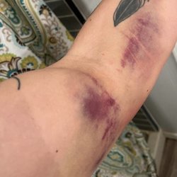 BioLife Plasma Services - Not sure what to say. Severe trauma and bruising. Not worth $50. The ER or urgent care visit is way more expensive.