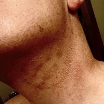 Joie de Vivre Medical - Almost 3 months after coolsculpting treatment by Joie de Vivre Medical - Medical Spas Near Me - Bloomington, Indiana Joie de Vivre Medical - Almost 3 months after coolsculpting treatment by Joie de Vivre Medical - Medical Spas Near Me - Bloomington, Indiana