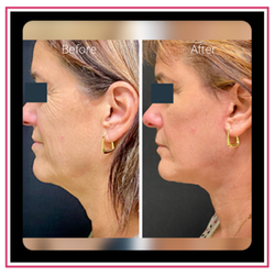 Pasqual Bracero, MD - Orlando Center For Womens Health - Face/Neck Lift w/CO2 Laser Skin Resurfacing