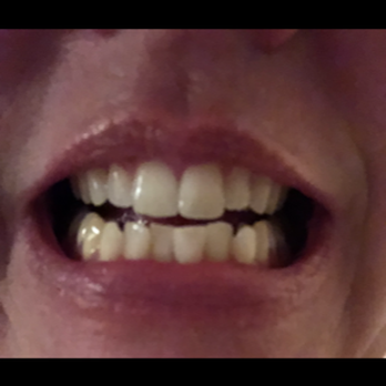 Ross Orthodontics - Greenville - Before.... - Orthodontists Near Me - Greenville, North Carolina