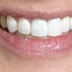 The Crown Dental Arts - After