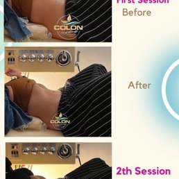 Laying in the colonic table with before and after. Laying in the colonic table with before and after.