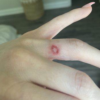 Fabulously Flawless Permanent Cosmetics - This is the day of; all of the skin is missing in that bottom half of the circle; she literally DUG MY SKIN OUT - Permanent Makeup Near Me - Raleigh, North Carolina