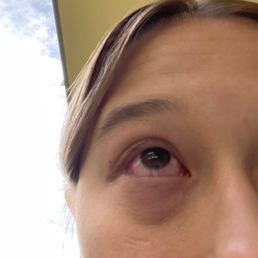 eye infection eye infection