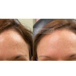 Laser to treat brown spots