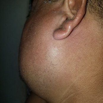 Sunset Marina Resort - My husbands reaction to the bite. - Resorts Near Me - Cancún, ROO