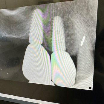 Carson Dental - 2 Right Upper Dental Implants - General Dentistry Near Me - Carson, California Carson Dental - 2 Right Upper Dental Implants - General Dentistry Near Me - Carson, California