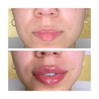 Le Rose Beauty Ave - Lip filler - Waxing Near Me Le Rose Beauty Ave - Lip filler - Waxing Near Me
