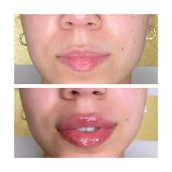 Le Rose Beauty Ave - Lip filler