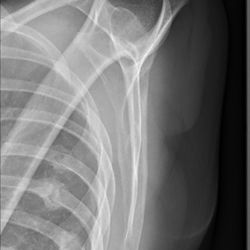 Adam E Shestack, MD - Florida Pain Management Institute - Broken ribs that dr shestack didn't see in the X-ray nor believe was the cause of my pain- he said it's anxiety and depression!