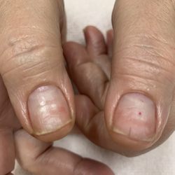 La Petite Nails - Damage after 4 months of powder dip manicure at Pearl Nails in Carlsbad. Notice the top half of split and paper thin nails.