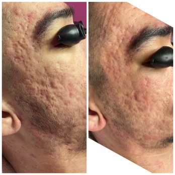 Racksi's Skinic - Working on skin texture after calming all of acne (grade IV acne client) going on 7 months strong with strict home care routine - Massage Near Me - West Covina, California