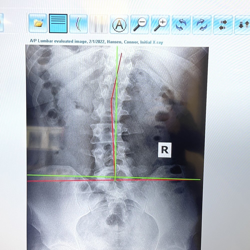 CorePosture Chiropractic - My lower back, spine before treatment. - Chiropractors Near Me - Newport Beach, California CorePosture Chiropractic - My lower back, spine before treatment. - Chiropractors Near Me - Newport Beach, California