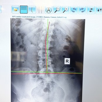 CorePosture Chiropractic - My lower back, spine before treatment. - Chiropractors Near Me - Newport Beach, California CorePosture Chiropractic - My lower back, spine before treatment. - Chiropractors Near Me - Newport Beach, California
