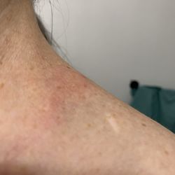Sharp Memorial Hospital - Hives, a itchy Rash I got on my left neck. An Allergic Reaction.