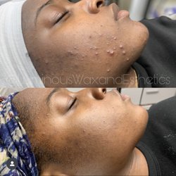 Luminous Wax And Esthetics - Acne Bootcamp