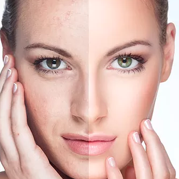 Bare Bliss Plus - Photo Facial - Laser Hair Removal Near Me - Glendale, New York