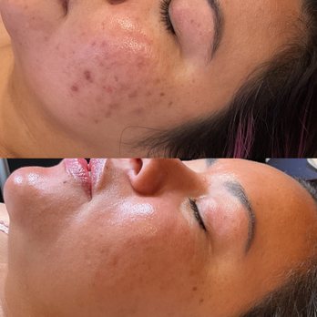 Diosa Esthetics - Pigmentation (before and after) - Waxing Near Me - Austin, Texas Diosa Esthetics - Pigmentation (before and after) - Waxing Near Me - Austin, Texas