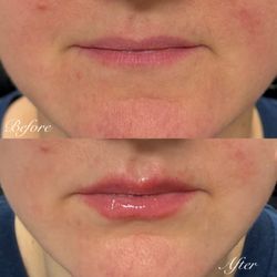 Beauty & The Babe - Subtle lip filler