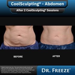Abdomen Fat Reduced After 2 CoolSculpting Sessions
