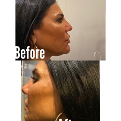 Bell K Nicole, DDS - Skin tightening with threads for under neck area.