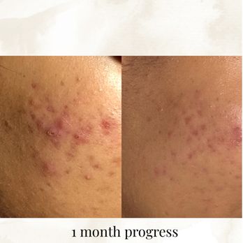 SkynCyn - Skin Care Near Me - Fontana, California SkynCyn - Skin Care Near Me - Fontana, California
