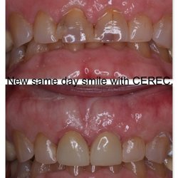 Rick Jaeger, DDS - Crowns placed on two front teeth due to old fillings and cracking, same day smile with CEREC technology.