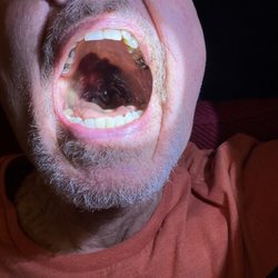 Wellstar Kennestone Hospital - Post intubation