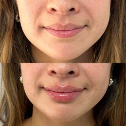 Carlos Nusenovich, RN - Lip fillers
