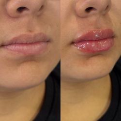 Lip Filler Before & After