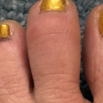 Vinci Nails - Reddish swollen toe - Nail Salons Near Me - Des Plaines, Illinois Vinci Nails - Reddish swollen toe - Nail Salons Near Me - Des Plaines, Illinois