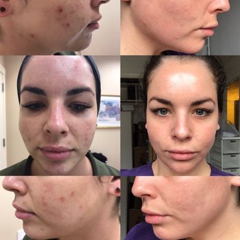 Jennifer Walden - Left: Day of peel w/ Courtney, 11/04/16. Right: 11/09/16, no makeup. Lips - 0.5ml (majority in upper) by Kristin in early 10/16 - Cosmetic Surgeons Near Me - Austin, Texas Jennifer Walden - Left: Day of peel w/ Courtney, 11/04/16. Right: 11/09/16, no makeup. Lips - 0.5ml (majority in upper) by Kristin in early 10/16 - Cosmetic Surgeons Near Me - Austin, Texas