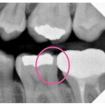 New Smile Dental Studio - Over shaven tooth to make crown fit. Bad work by a so called "dentist" Dr. Martinez - Cosmetic Dentists Near Me - Glendale, California New Smile Dental Studio - Over shaven tooth to make crown fit. Bad work by a so called "dentist" Dr. Martinez - Cosmetic Dentists Near Me - Glendale, California