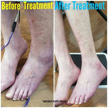 Superior Wellness - Peripheral Neuropathy Reversal photo of before the treatment program and after, says it all! - Chiropractors Near Me - Brentwood, Tennessee Superior Wellness - Peripheral Neuropathy Reversal photo of before the treatment program and after, says it all! - Chiropractors Near Me - Brentwood, Tennessee