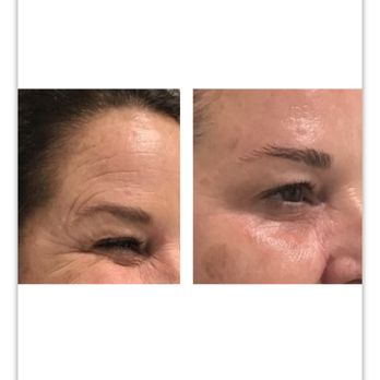 BioLift Med Spa - Crows feet tox - Acne Treatment Near Me - Boynton Beach, Florida BioLift Med Spa - Crows feet tox - Acne Treatment Near Me - Boynton Beach, Florida