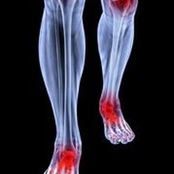 OSSM Orthopedics - There are over 100 different types of arthritis. The most common are: Osteoarthritis, Rheumatoid arthritis, Fibromyalgia, Gou...