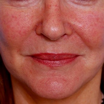 NOVA Surgicare, PC - Before lip implants - Oral Surgeons Near Me - Mclean, Virginia