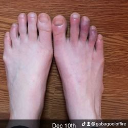 Highland Park Emergency Room - Purple toes start