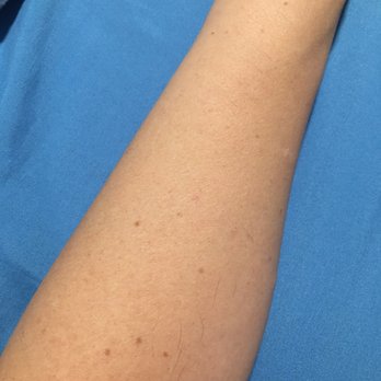 Contours - My arm after maybe 4 treatments of laser hair removal. Have not shaved. Only a few thin hairs left - Medical Spas Near Me - Laguna Hills, California